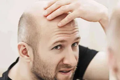 types of alopecia