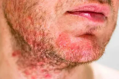 folliculitis