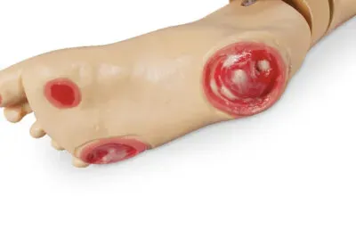 pressure ulcers 